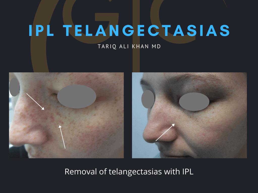 Gentle Care Laser Tustin & Long Beach Before and After picture - IPL telangectasia